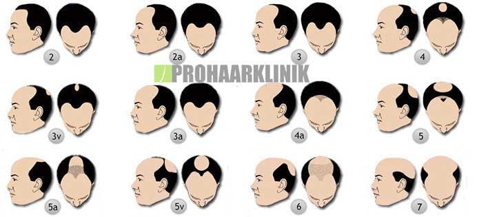 Haartransplantation Erfahrungen Österreich
