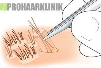 FUE Haartransplantation Erfahrungen