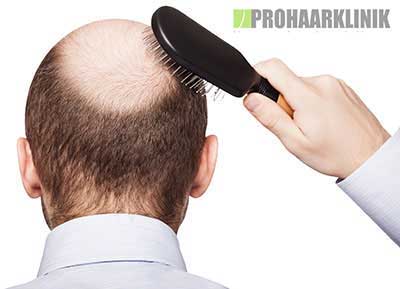 Haartransplantation Erfahrungen